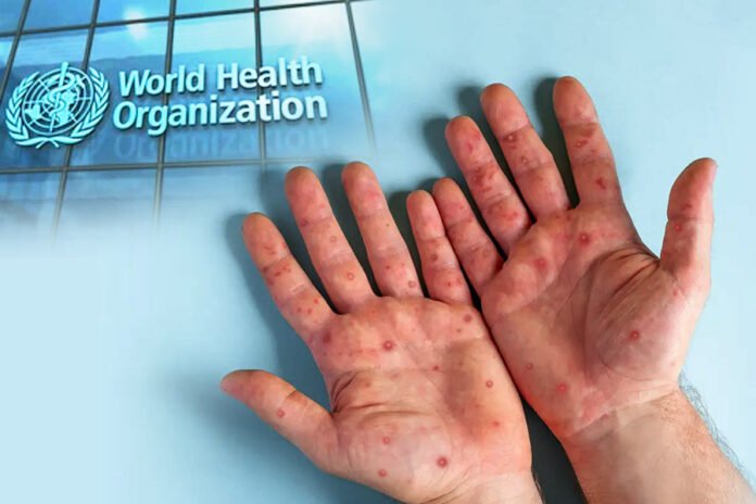 मंकी पॉक्स